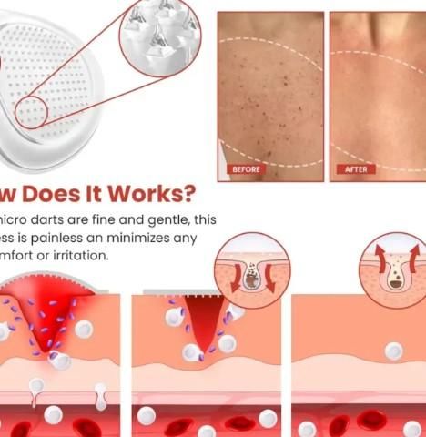 Best Skin Tag Remover Patches - 144 Pcs Natural Removal Kit for All Skin Types